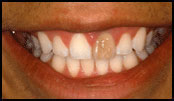 Before Treatment