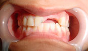 Before Treatment